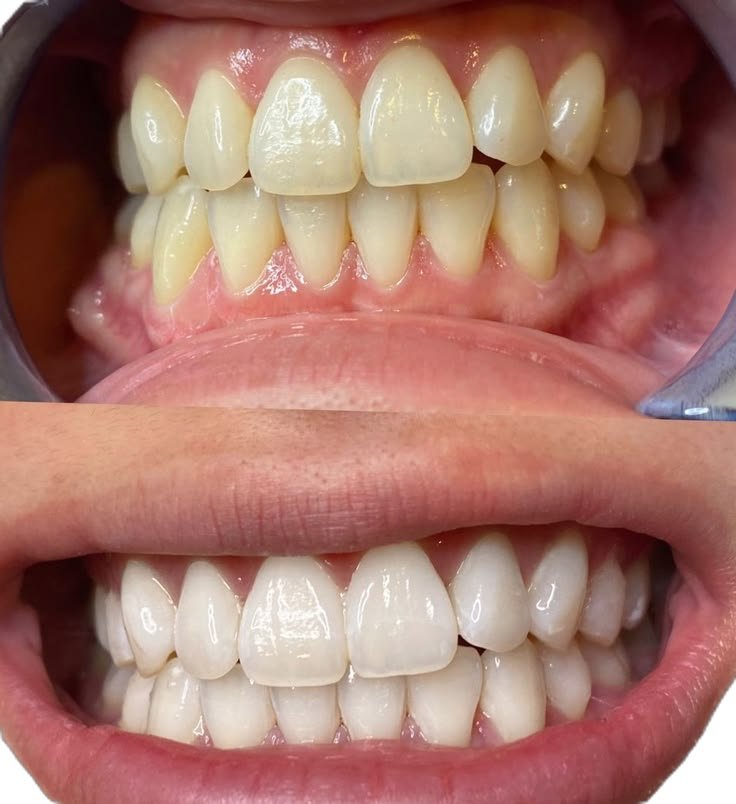 Teeth whitening in jabalpur