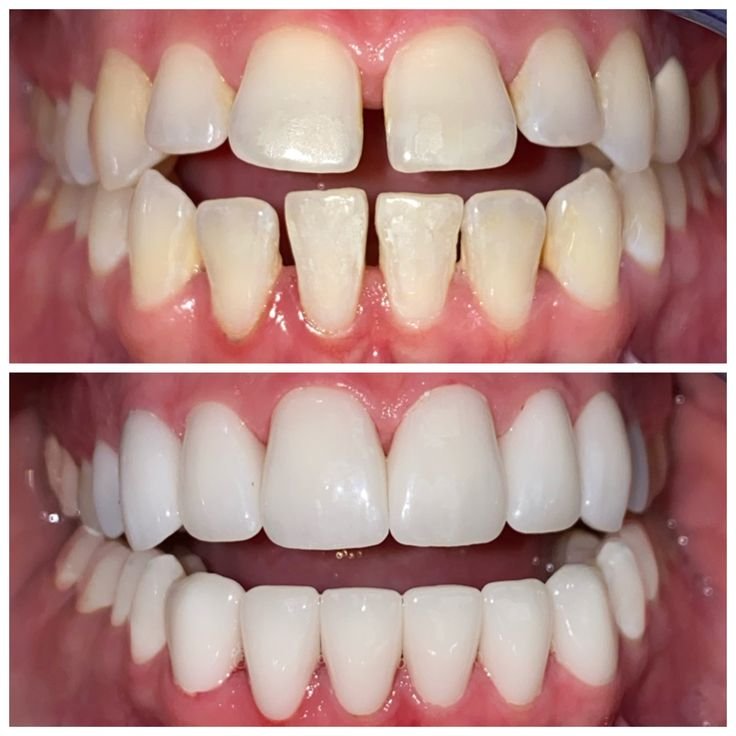 Smile Makeover in Jabalpur