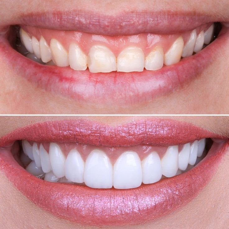 Smile Makeover in Jabalpur