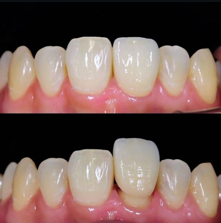 Dental crown in jabalpur