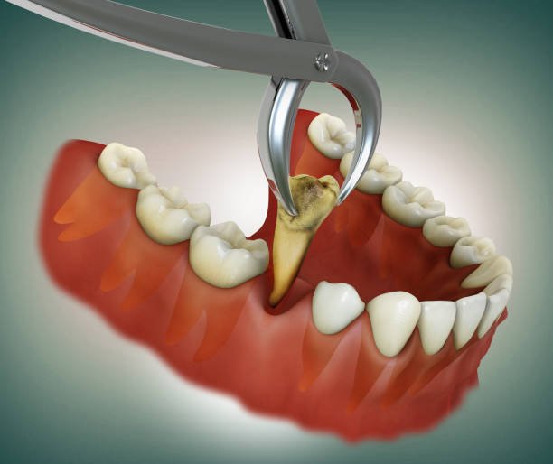 Painless tooth extraction at Anuraag Dental Care & Implant Centre in Jabalpur